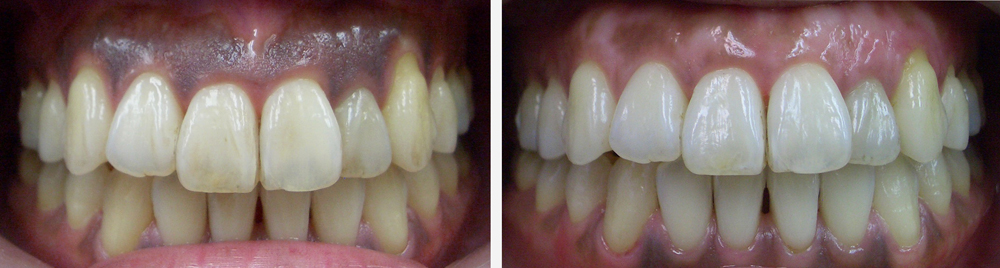 葛飾区高見歯科クリニックのホワイトニング写真７