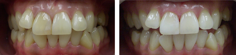 葛飾区高見歯科クリニックのホワイトニング写真２