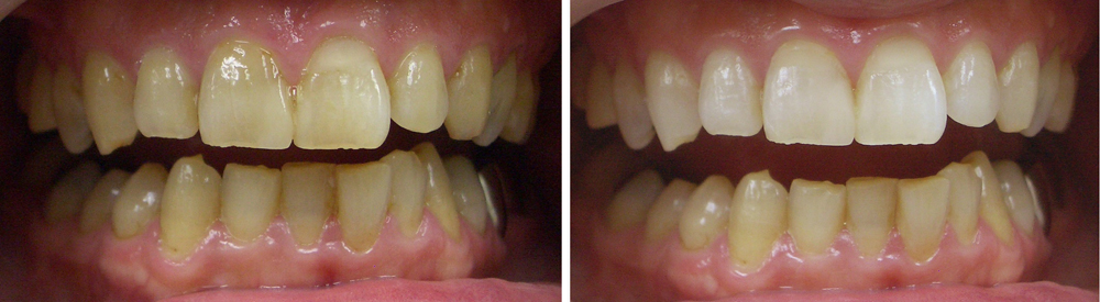葛飾区高見歯科クリニックのホワイトニング写真５