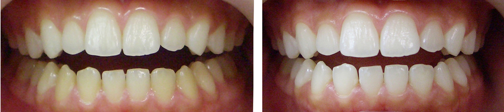 葛飾区高見歯科クリニックのホワイトニング写真１