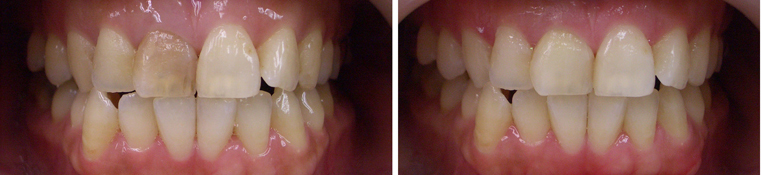 葛飾区高見歯科クリニックのホワイトニング写真６